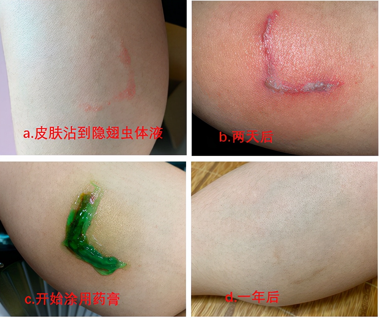 隱翅蟲的毒（dú）性有多強？體液比眼（yǎn）鏡蛇更毒，捕蠅草（cǎo）吸收（shōu）它都會枯萎